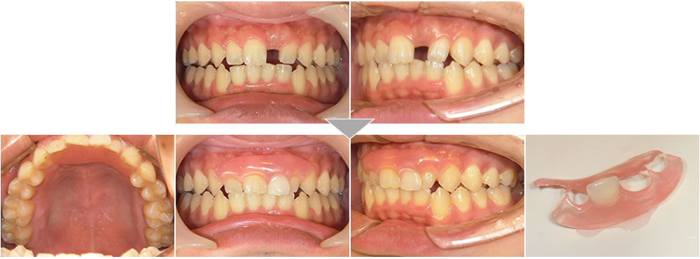 前歯のオーダーメイド審美義歯(コンフォートデンチャー)症例