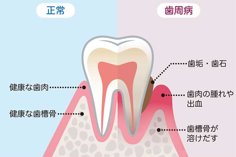 歯周病