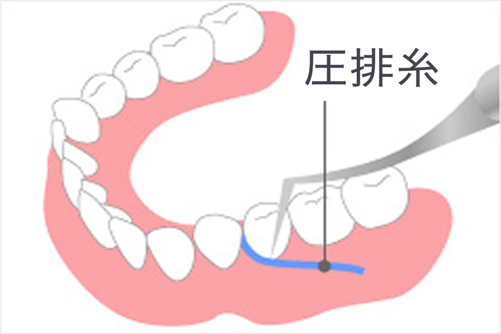 つめ物・被せ物(審美歯科) |埼玉県西川口の歯医者