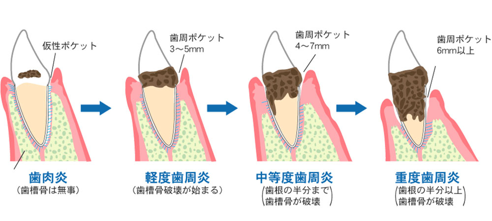 一般的な歯周病治療