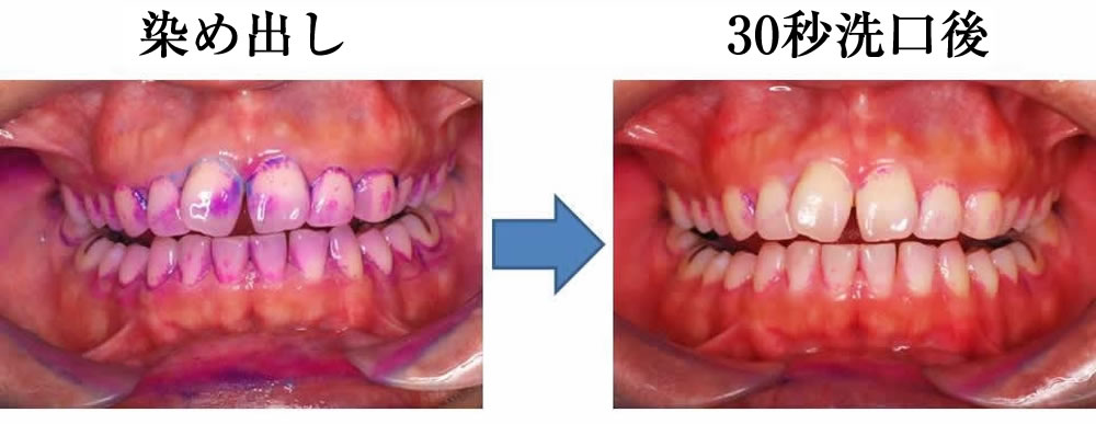 30秒間洗口