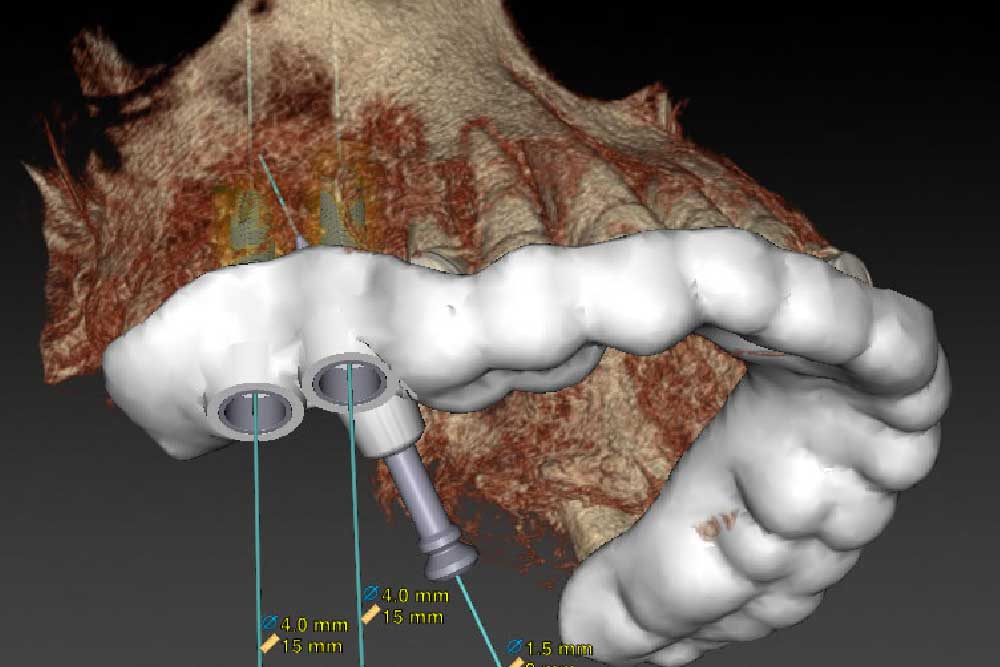 ガイドステント