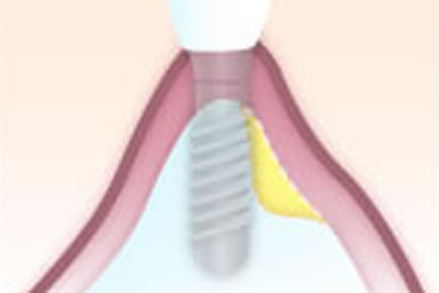 GBR(骨再生療法)